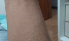 梦见胳膊上有肉疙瘩_(梦到胳膊上长满小肉瘤)