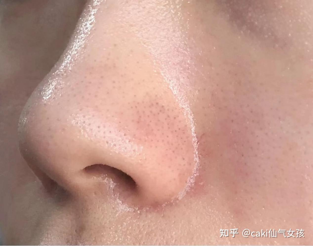 鼻翼长毛什么命理好呢_(鼻翼长毛是出了什么问题)