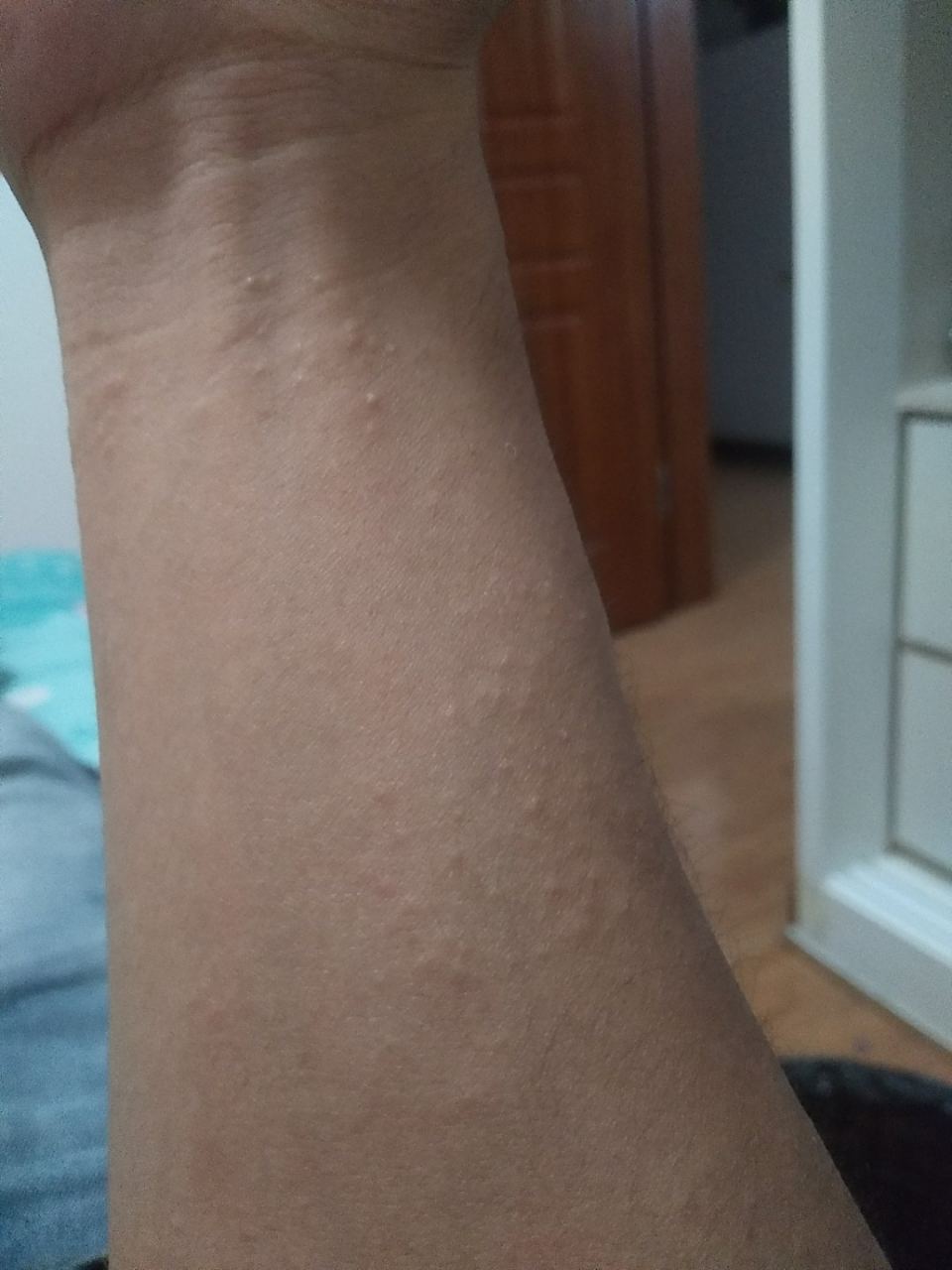 梦见胳膊上有肉疙瘩_(梦到胳膊上长满小肉瘤)